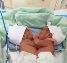 Bayi Kembar Siam Dempet Perut Lahir di RSUP Haji Adam Malik