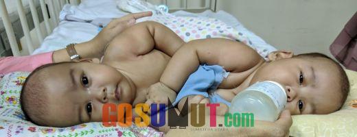 Bayi Kembar Siam Asal Taput Direncanakan Akan Operasi Pemisahan