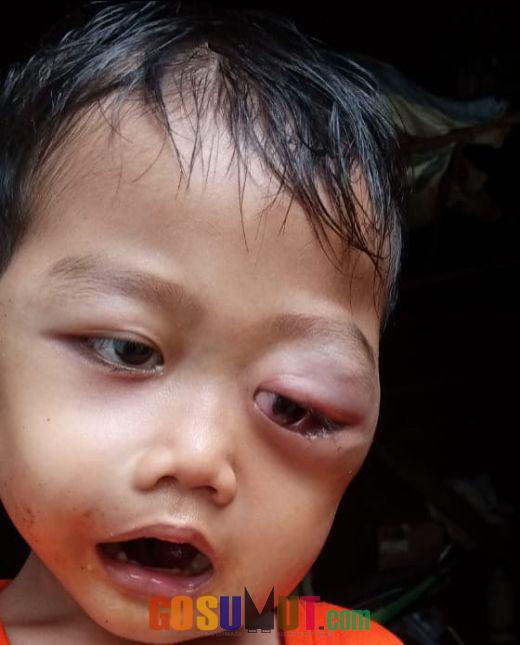 Bocah Menderita Diagnosa Tumor Mata di Palas Butuh Bantuan Dermawan
