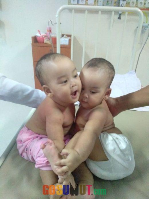 Kini Bayi Kembar Siam di RSUP H Adam Malik Tumbuh Sehat dan Aktif