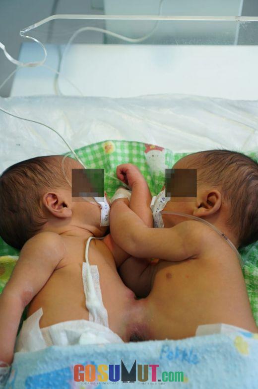 RS Adam Malik Rawat Bayi Kembar Siam Asal Taput